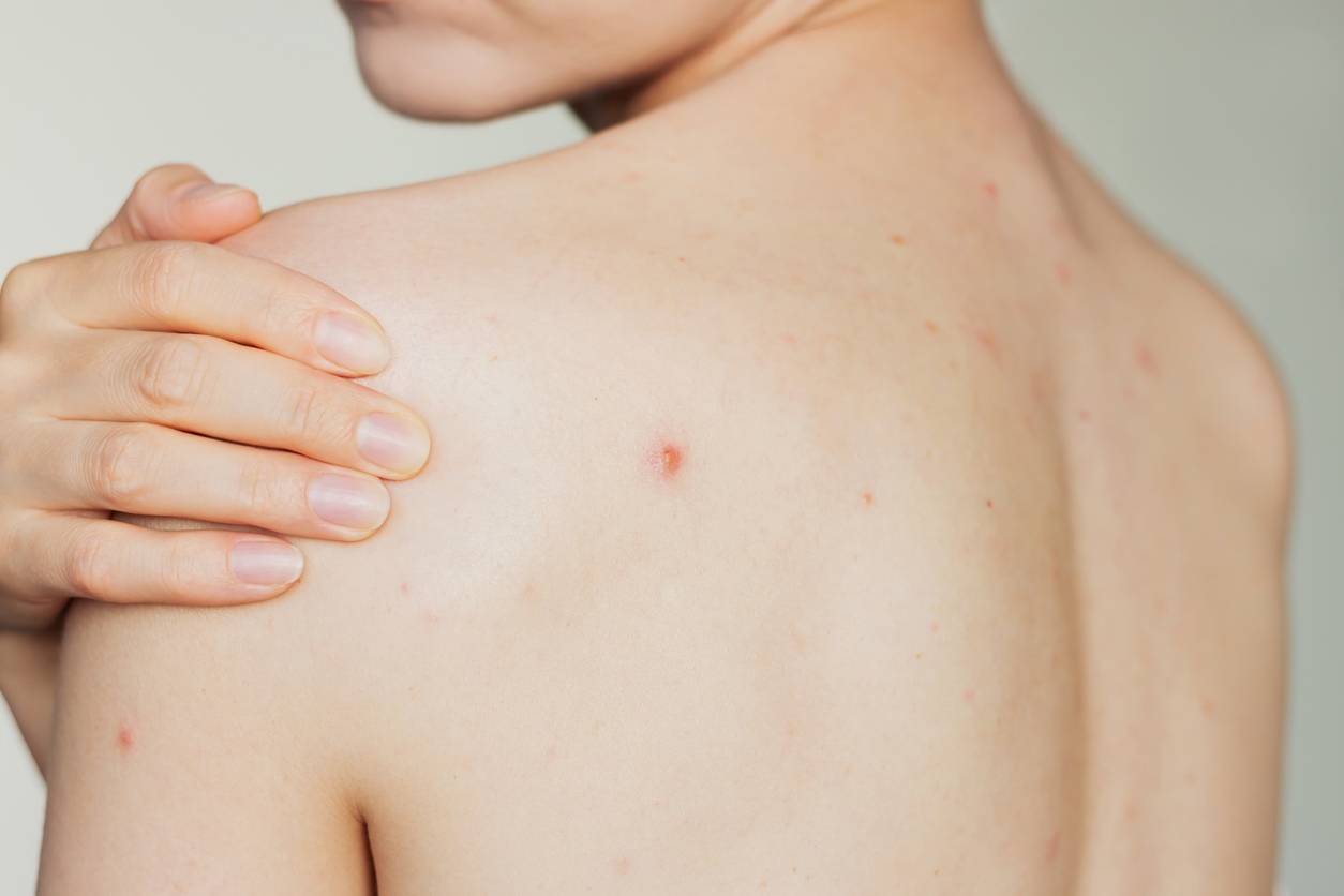 Jerawat Punggung Bikin Nggak Pede? Ini Body Acne Spray yang Wajib Dicoba