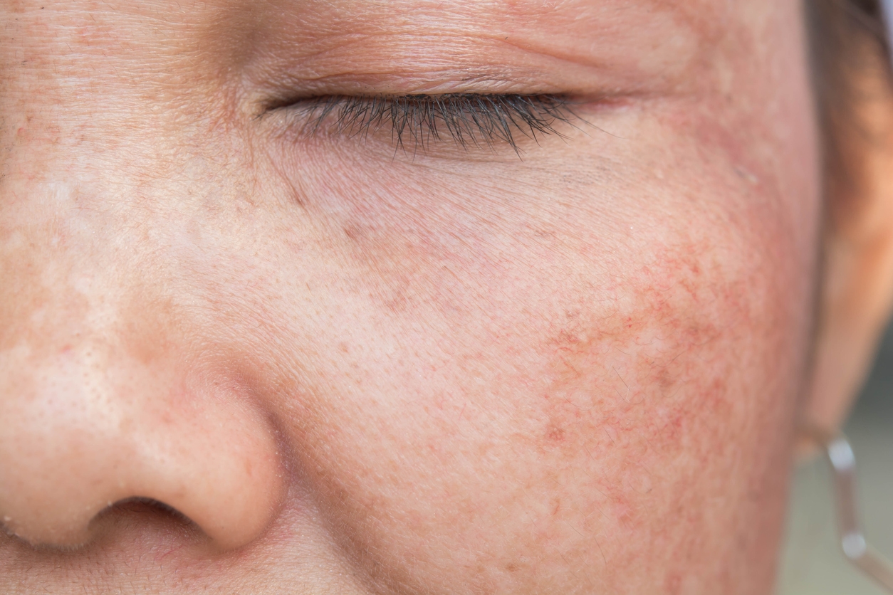 Bukan Flek Hitam Biasa, Kenali Penyebab Melasma