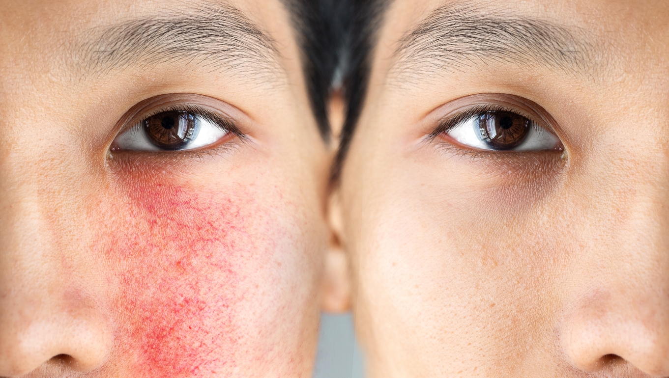 Apa Itu Rosacea? Kenali Penyebab, Gejala, dan Cara Mengatasinya